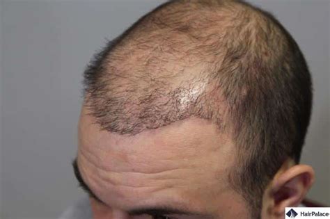 Hair Transplant Gone Wrong A Look At The Biggest Risks