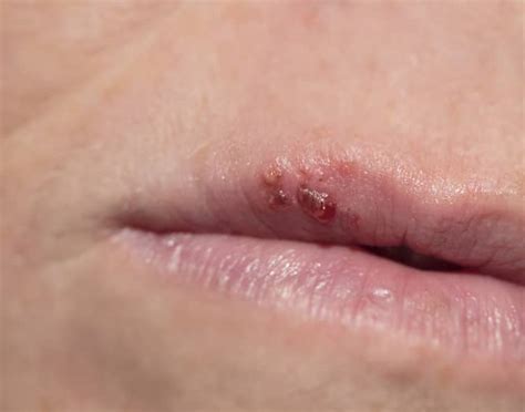 Can Really Dry Lips Cause Cold Sores
