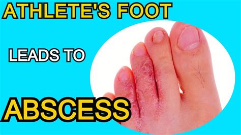 Athletes Foot Leads To Abscess Drain New Release Youtube