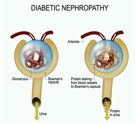 Diabetic Nephropathy Pathophysiology