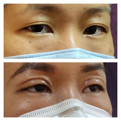 Double Eyelid Surgery Blepharoplasty In Bangalore Venkat Center
