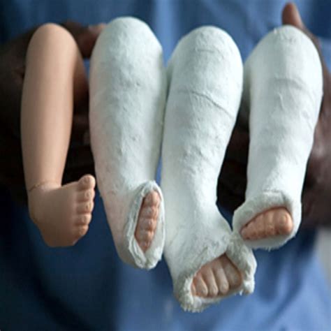 Clubfoot Baby Ponseti Baby In Casts Photo By Amanda Price Clubfoot