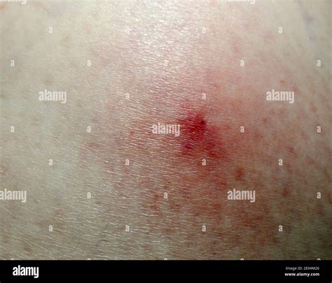 Redness And Tick Bite Marks On The Skin Stock Photo Alamy