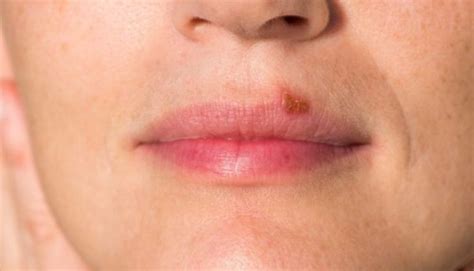 Pin On Best Essential Oils For Fever Blisters On Lips