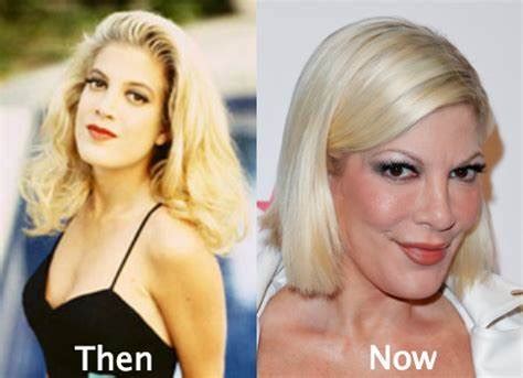 Tori Spelling Plastic Surgery With Before And After Photos