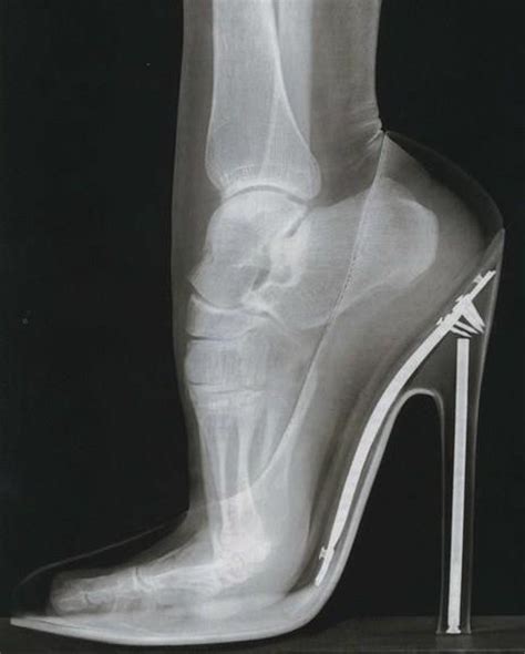 Shoe Salesmen X Rays ‘pedoscope Blog