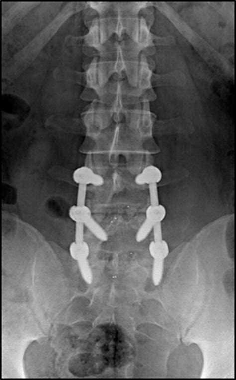 Spinal Reconstruction And Fusion