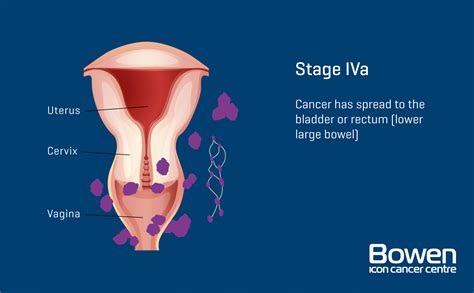 What Is Cervical Cancer Cervical Cancer Explained Bowen Icon Cancer