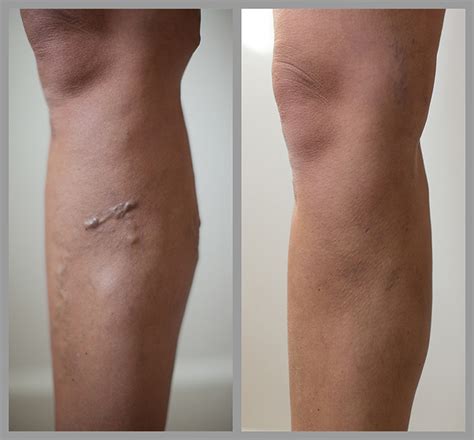 Varicose Vein Before And After Photographs The Private Clinic