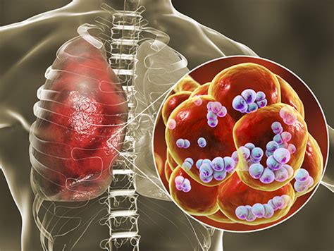 S Pneumoniae Sticks To Dying Lung Cells Worsening Secondary Infection