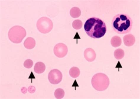 Although more often diagnosed in. What percent of elliptocytes in one's blood would conclude having hereditary spherocytosis? Is ...