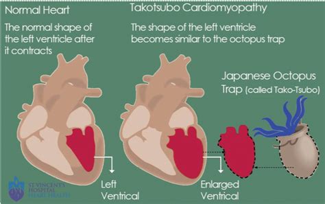 Intense Stress Can Damage The Heart Takotsubo Syndrome