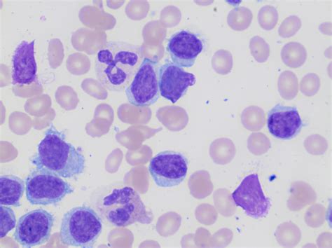 Lymphocytosis Can Be Anything Lablogatory