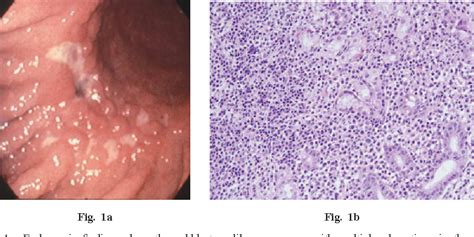 Figure 1 From A Case Of Api2 Malt1 Positive Gastric Malt Lymphoma With