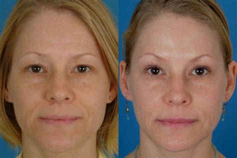 Botox 2 Dallas Advanced Facial Plastic Surgery Center