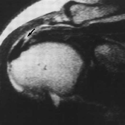 Supraspinatus Tendon Tear On Magnetic Resonance Imaging From Matava Et