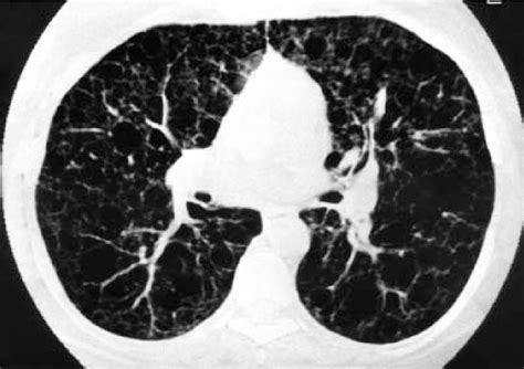 Figure 1 From Pulmonary Involvement In Tuberous Sclerosis Complex