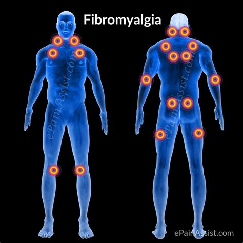 Faq On Fibromyalgiasymptoms11 Painful Trigger Pointscausesrisk Factors