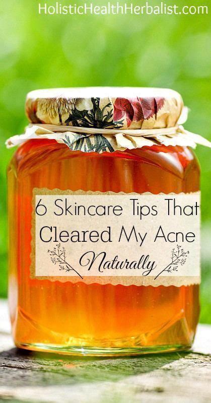 6 Skincare Tips That Cleared My Acne Naturally Learn About My Top