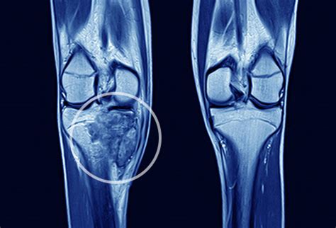 A rare type of bone cancer in dogs, fibrosarcoma occurs in less than 5% of all bone cancer cases. Visual Guide to Bone Cancer