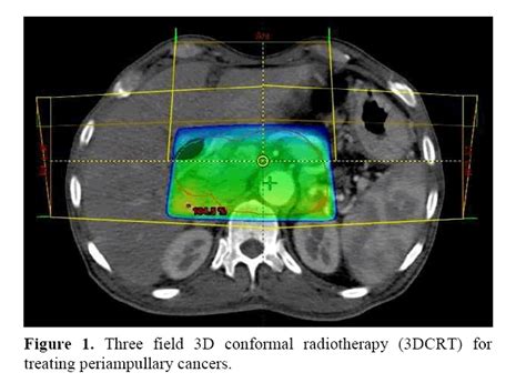 Dosimetric Comparison Of Doses To Organs At Risk Using 3 D Conformal