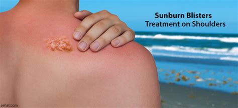 Best Sunburn Blisters Treatment On Shoulders