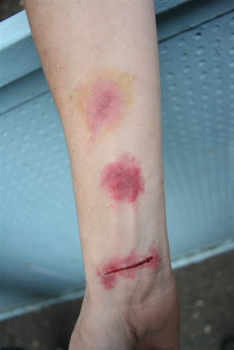 Bruises On Arm Viewing Gallery