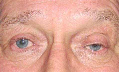 Correction Of Bilateral Drooping Upper Eyelids Ptosis Before Nissman Eye