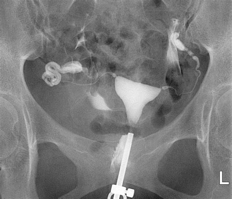 Hysterosalpingography Spectrum Of Normal Variants And 52 OFF