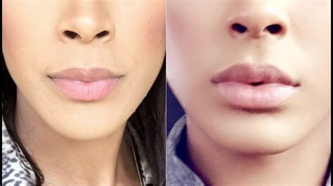 Lip Filler Before And After 1 Syringe Before And After
