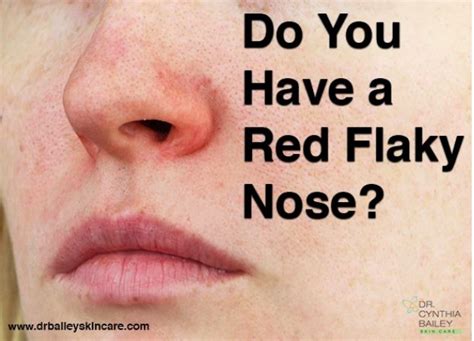 Do You Have A Red Flaky Nose Dry Nose Skin Flaky Skin On Face