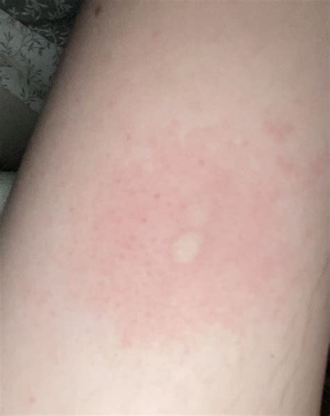 Weird Lump Suddenly Appeared On Arm By Implant Mumsnet