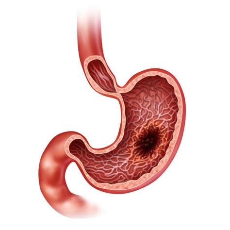 Top 60 Stomach Cancer Stock Photos Pictures And Images Istock