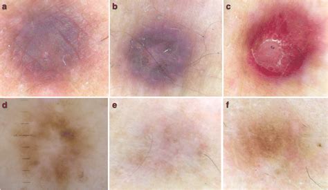Beyond Classic Dermoscopic Patterns Of Dermatofibromas A Prospective