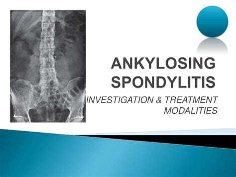 Ankylosing Spondylitis Management