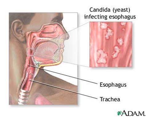 Candidal Esophagitis MedlinePlus Medical Encyclopedia Image