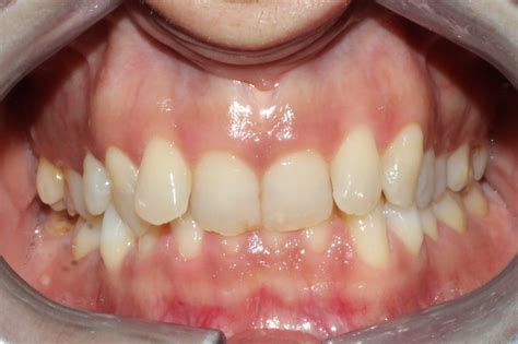 ¿qué Es La Maloclusión Dental Dentista En Murcia Clínica Dental En