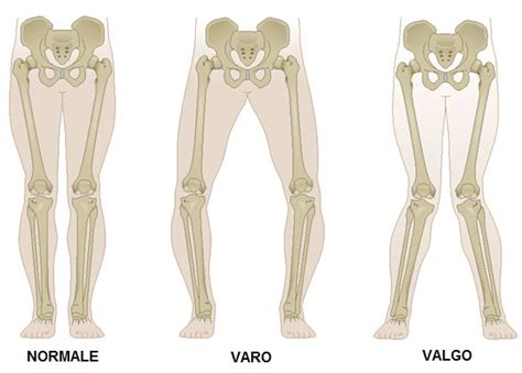 Ginocchio Varo Valgo Fisio Bregma