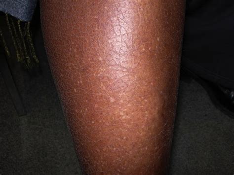 épingle Graisse Image White Spots On Legs La Tour évasion De La Prison