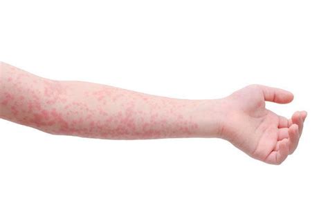 Scarlet Fever Signs And Symptoms In Children As Cases On The Rise In