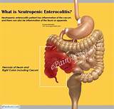 Pictures of Neutropenic Enterocolitis Treatment