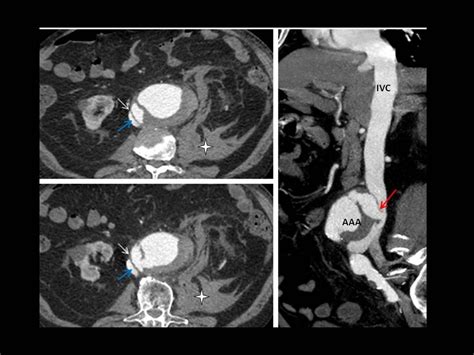 Aorto Caval Fistula Complicating An Abdominal Aortic Aneurysm Eurorad