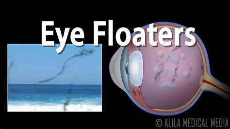 Eye Floaters And Flashes Animation Floaters And Flashes Eye