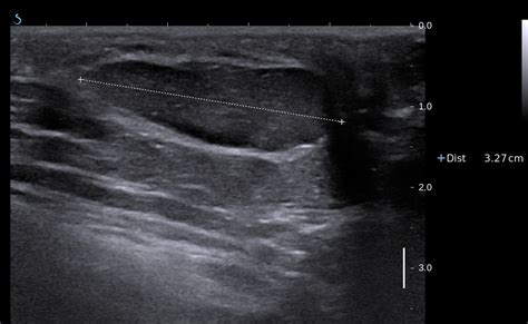 Vietnamese Medic Ultrasound Case Axillary Mammary Gland Dr Phan