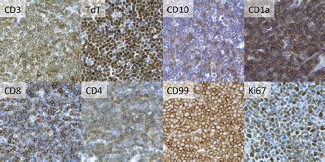 Immunophenotype And Staining Pattern Of A Case Of Indolent
