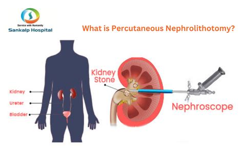 What Is Percutaneous Nephrolithotomy