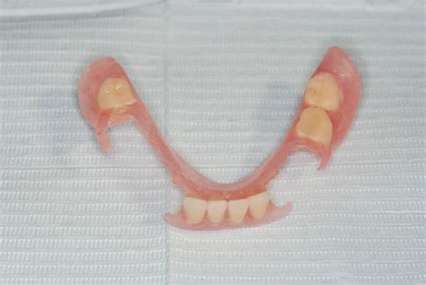 The Gallery For Lower Partial Dentures