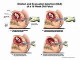 Home Abortions Methods