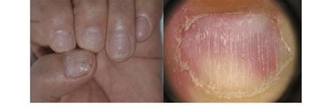 Alopecia Universalis Nails Nail Ftempo