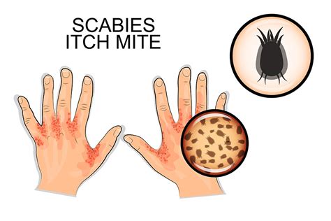 Scabies Causes Symptoms Treatment Pictures And Images